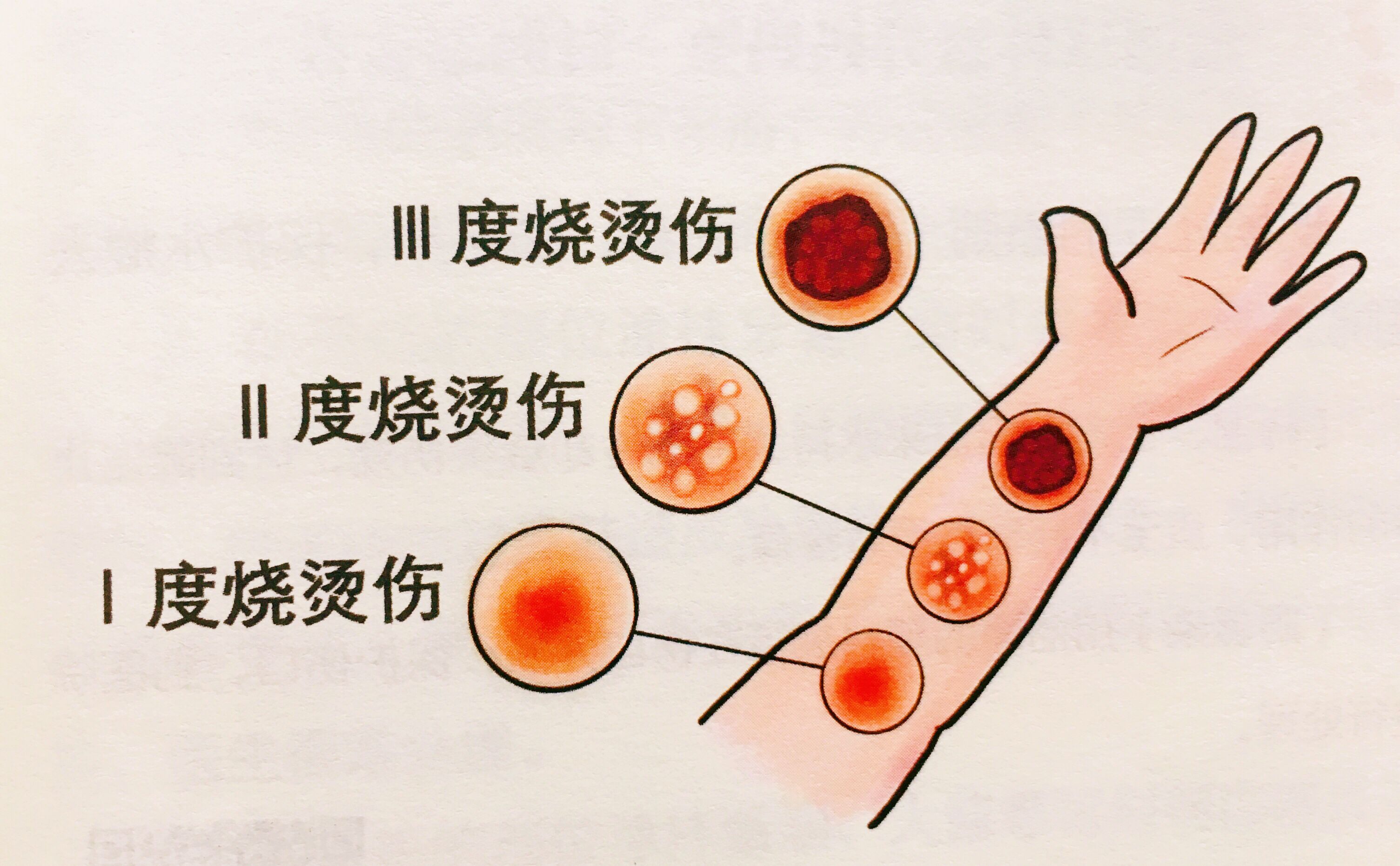 家庭常见烧烫伤的正确应对方法