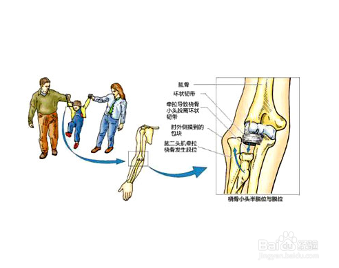 遇到脱臼时的家庭紧急处理措施